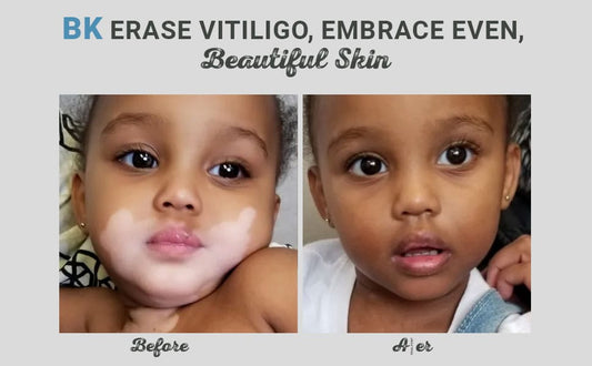 BK - A Complete End Of Vitiligo - (برس کا مکمل خاتمہ)